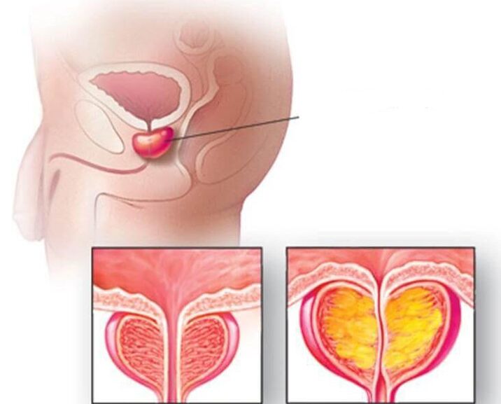 Location of the prostate gland, normal prostate and enlarged in chronic prostatitis